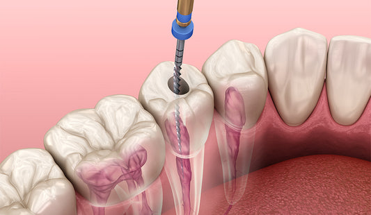 Why should I wear a crown after root canal therapy?