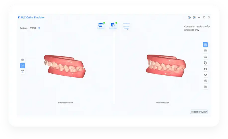 Orthodontic Simulation